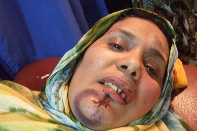 Dagna Moussaoui: mujer adulta. Herida abierta en la pierna y otra en la boca, con la pérdida de algunos dientes.