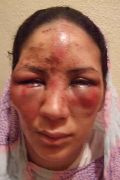 Mariem Mghaizlat: chica de 25 años. Cara desfigurada por la inflamación. Apaleada en todo el cuerpo.
